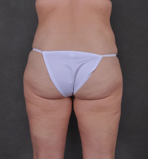 tummy tuck - patient 8786 - before 4 tummy tuck - patient 8786 - before 4