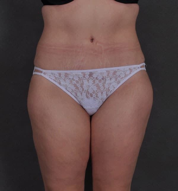 tummy tuck - patient 8786 - after 1 tummy tuck - patient 8786 - after 1