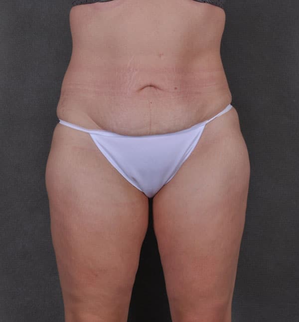 tummy tuck - patient 8786 - before 1 tummy tuck - patient 8786 - before 1