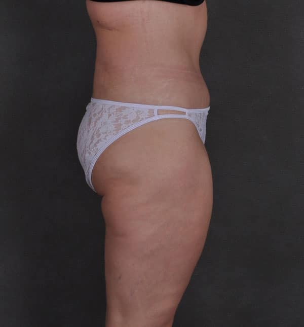 tummy tuck - patient 8786 - after 3 tummy tuck - patient 8786 - after 3