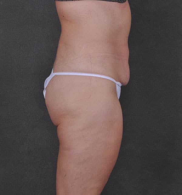tummy tuck - patient 8786 - before 3 tummy tuck - patient 8786 - before 3
