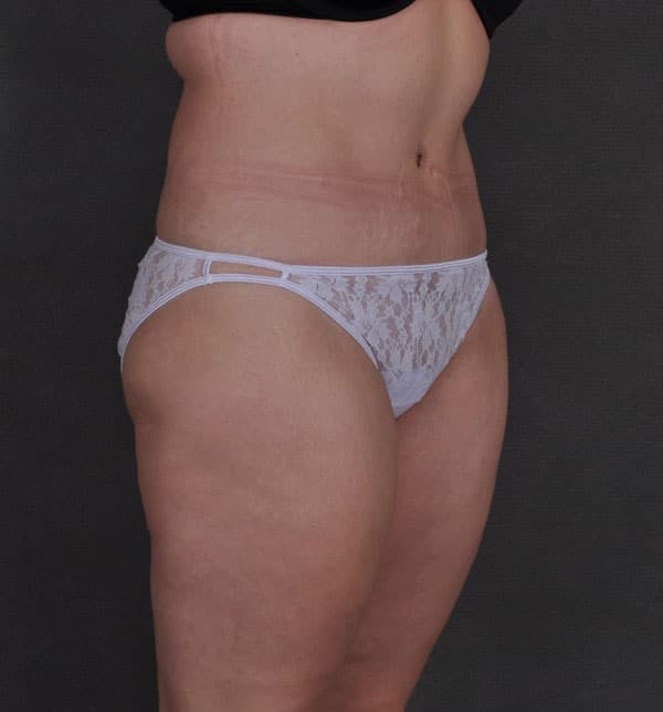 tummy tuck - patient 8786 - after 2 tummy tuck - patient 8786 - after 2