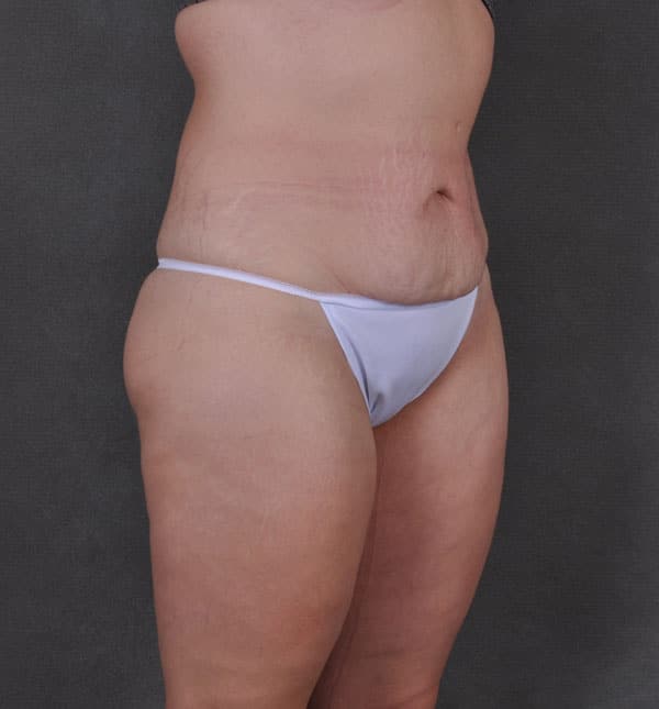 tummy tuck - patient 8786 - before 2 tummy tuck - patient 8786 - before 2