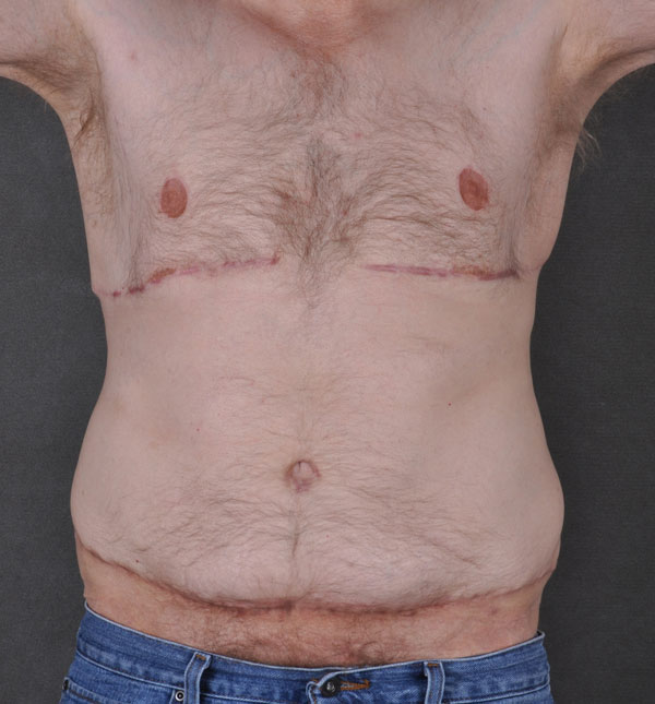 gynecomastia - patient 8866 - after 1 gynecomastia - patient 8866 - after 1