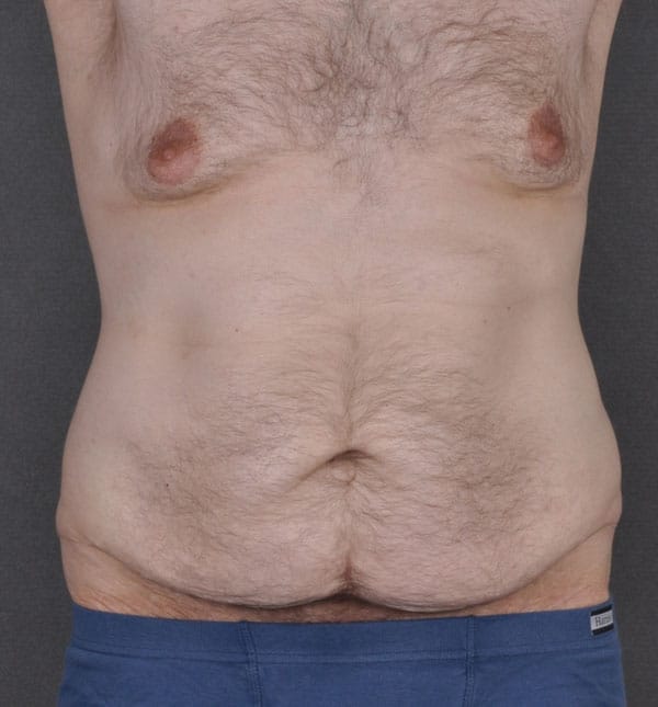 gynecomastia - patient 8866 - before 1 gynecomastia - patient 8866 - before 1