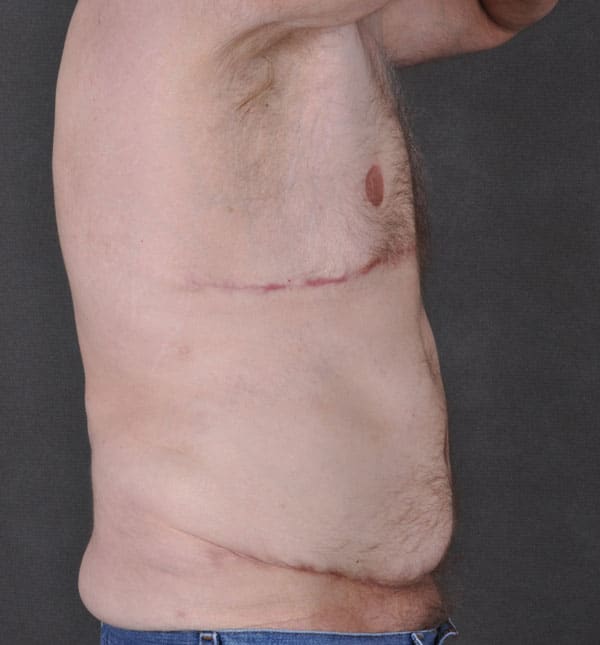 gynecomastia - patient 8866 - after 3 gynecomastia - patient 8866 - after 3