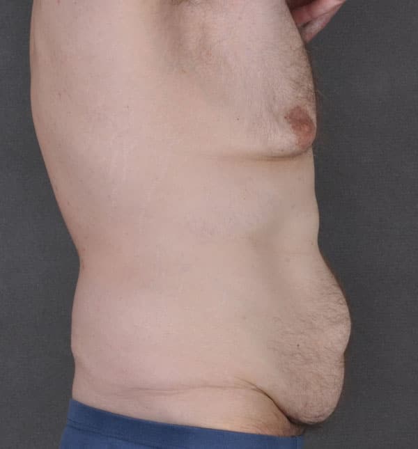 gynecomastia - patient 8866 - before 3 gynecomastia - patient 8866 - before 3