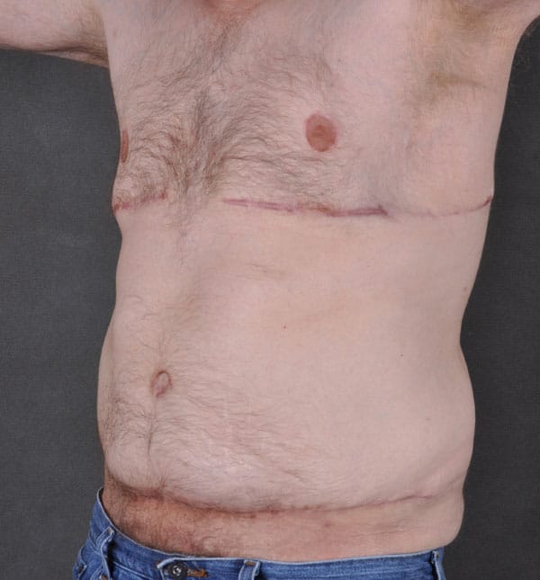 gynecomastia - patient 8866 - after 4 gynecomastia - patient 8866 - after 4