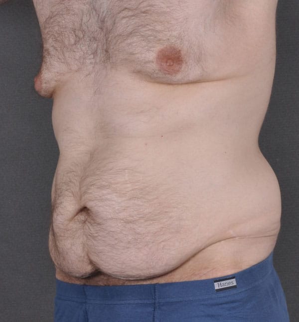 gynecomastia - patient 8866 - before 4 gynecomastia - patient 8866 - before 4