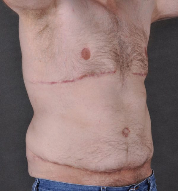 gynecomastia - patient 8866 - after 2 gynecomastia - patient 8866 - after 2