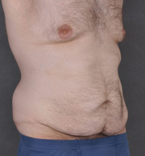 gynecomastia - patient 8866 - before 2 gynecomastia - patient 8866 - before 2