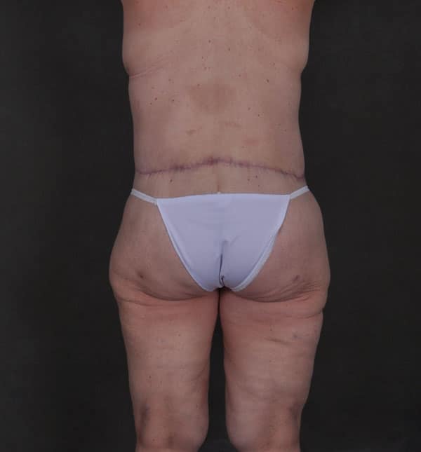 liposuction - patient 8910 - after 3 liposuction - patient 8910 - after 3