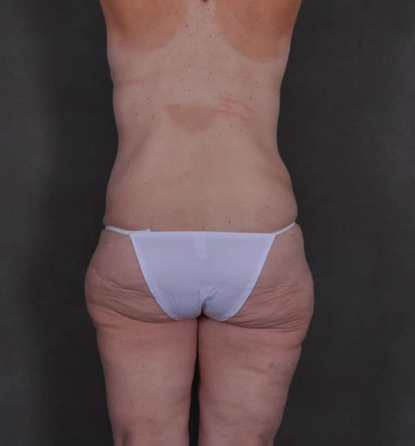 liposuction - patient 8910 - before 3 liposuction - patient 8910 - before 3