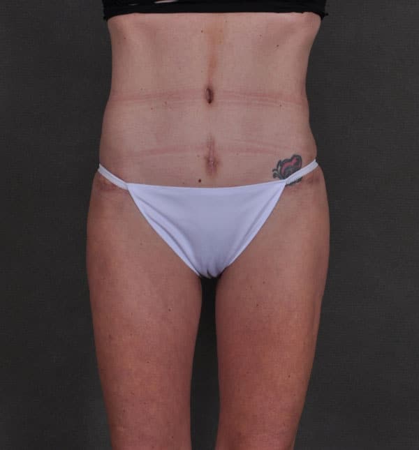 liposuction - patient 8901 - after 1 liposuction - patient 8901 - after 1