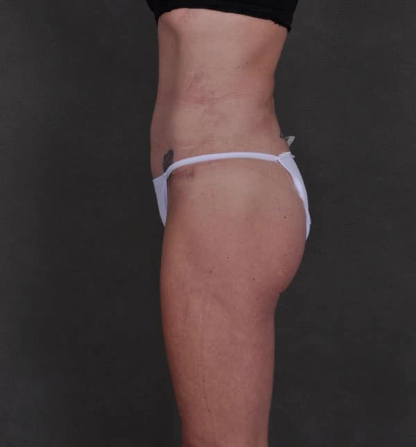 liposuction - patient 8901 - after 5 liposuction - patient 8901 - after 5