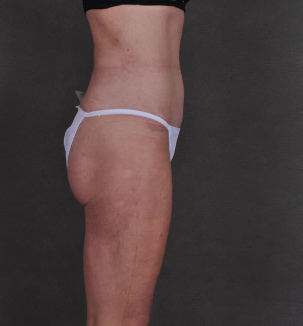 liposuction - patient 8901 - after 3 liposuction - patient 8901 - after 3