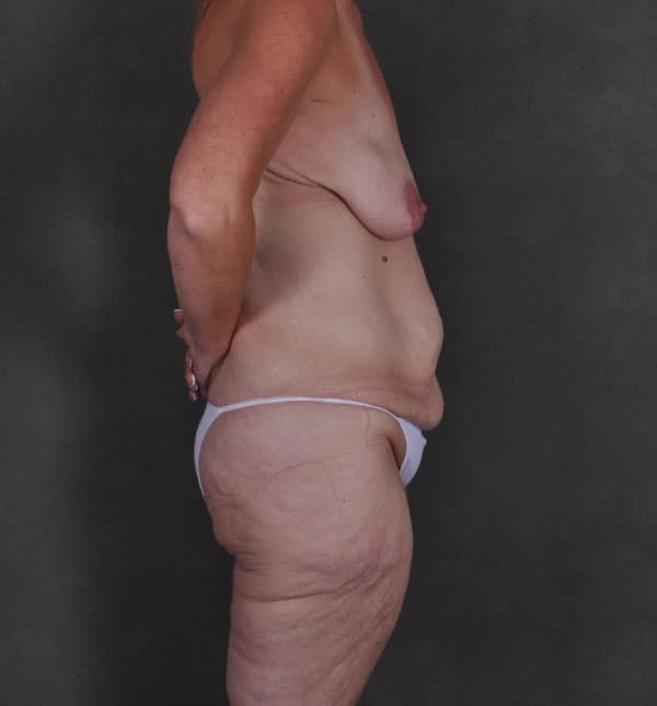 liposuction - patient 8910 - before 2 liposuction - patient 8910 - before 2