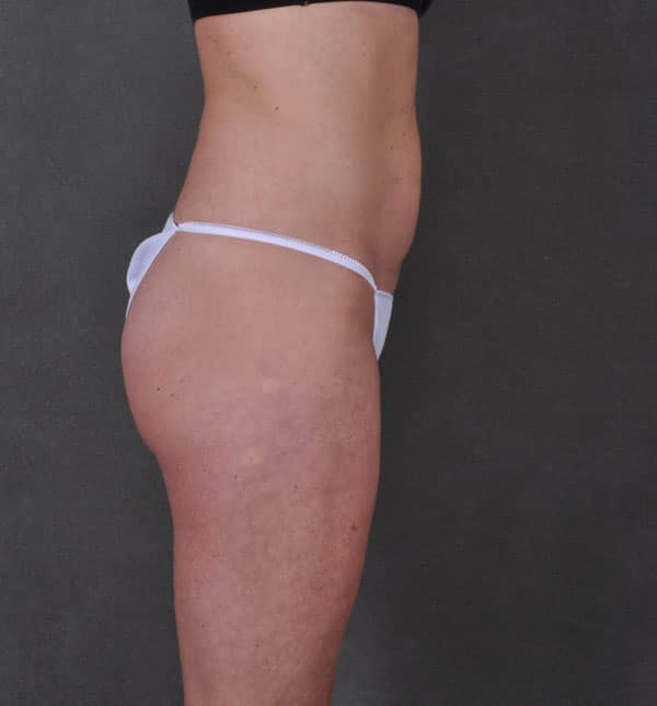 liposuction - patient 8901 - before 3 liposuction - patient 8901 - before 3