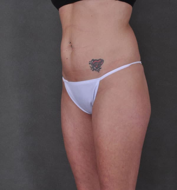 liposuction - patient 8901 - before 4 liposuction - patient 8901 - before 4