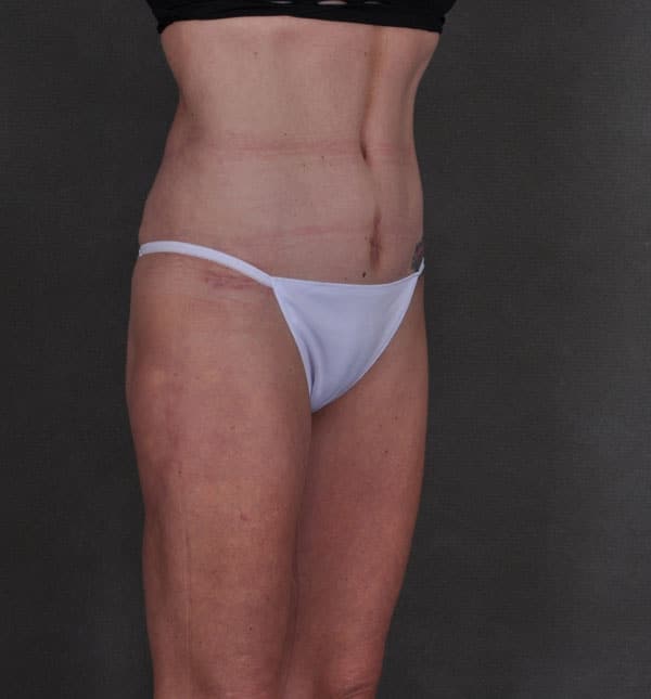 liposuction - patient 8901 - after 2 liposuction - patient 8901 - after 2