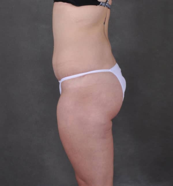 tummy tuck - patient 8941 - after 3 tummy tuck - patient 8941 - after 3
