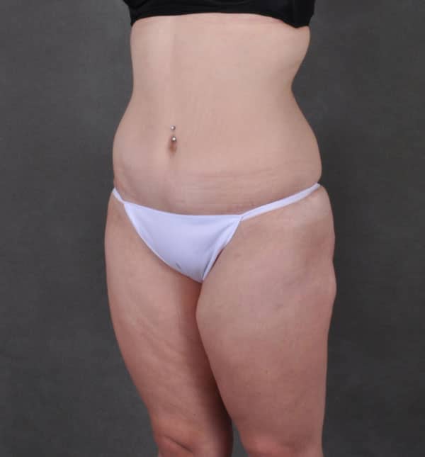 tummy tuck - patient 8941 - after 2 tummy tuck - patient 8941 - after 2