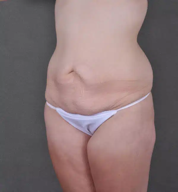tummy tuck - patient 8941 - before 2 tummy tuck - patient 8941 - before 2