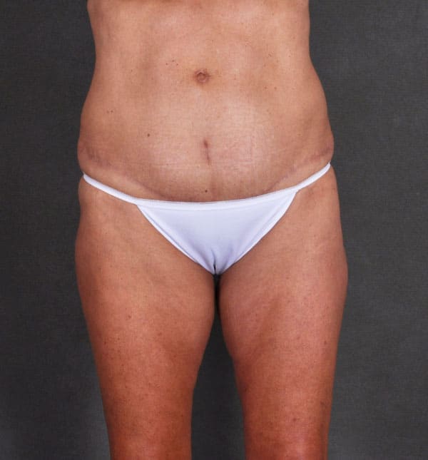 tummy tuck - patient 8968 - after 1 tummy tuck - patient 8968 - after 1