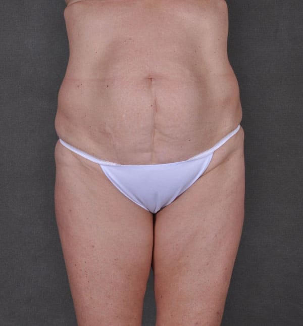 tummy tuck - patient 8968 - before 1 tummy tuck - patient 8968 - before 1