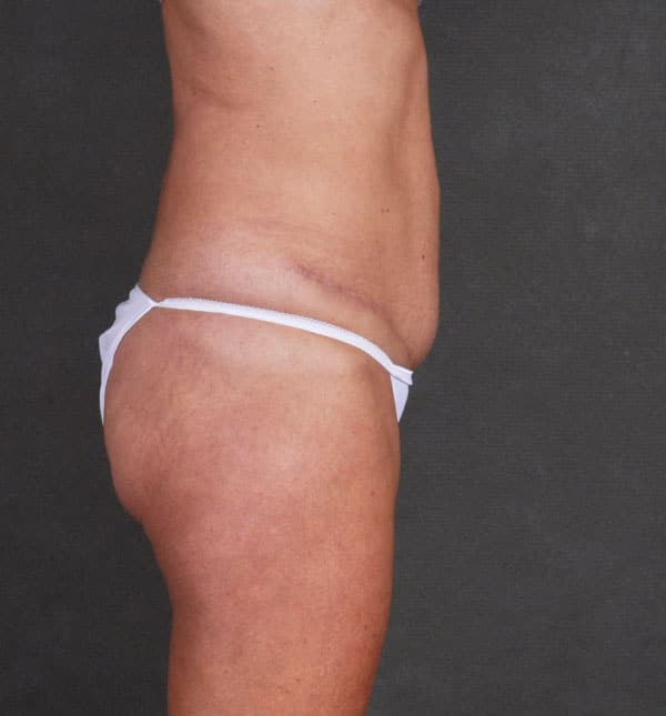 tummy tuck - patient 8968 - after 2 tummy tuck - patient 8968 - after 2