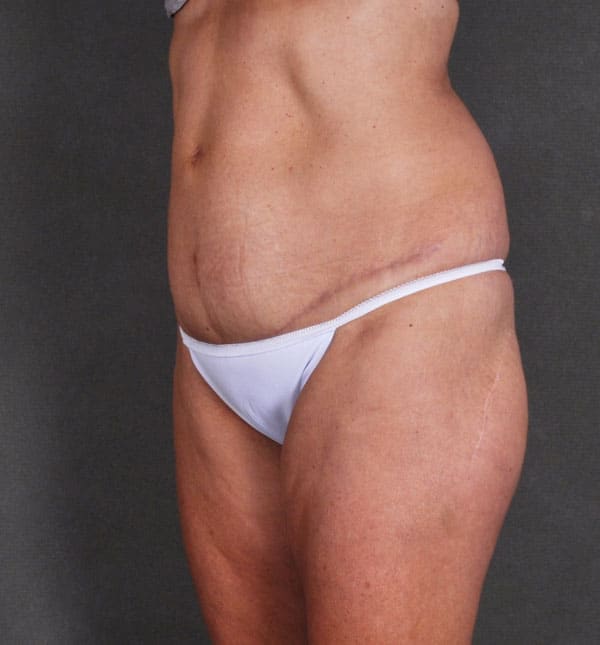 tummy tuck - patient 8968 - after 3 tummy tuck - patient 8968 - after 3
