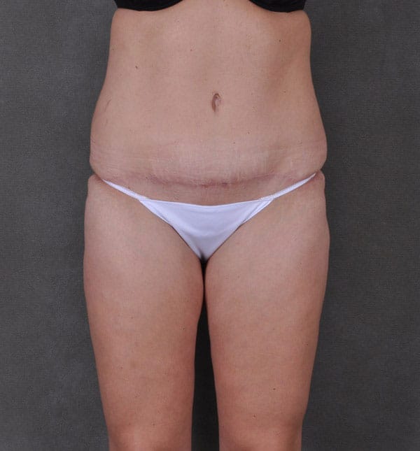 tummy tuck - patient 9171 - after 1 tummy tuck - patient 9171 - after 1