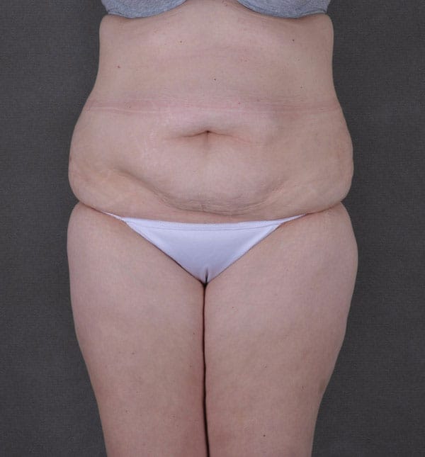 tummy tuck - patient 9171 - before 1 tummy tuck - patient 9171 - before 1
