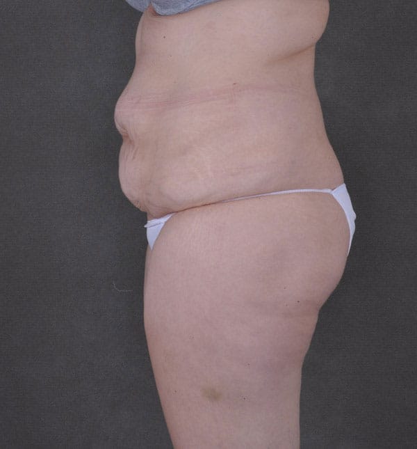 tummy tuck - patient 9171 - before 5 tummy tuck - patient 9171 - before 5