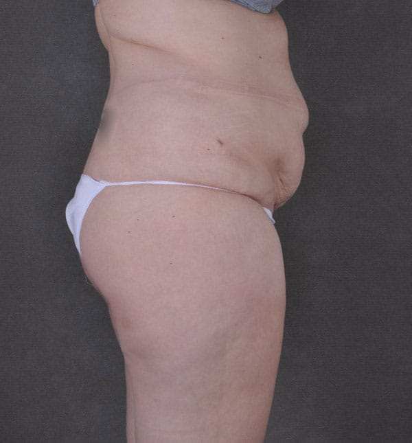tummy tuck - patient 9171 - before 3 tummy tuck - patient 9171 - before 3