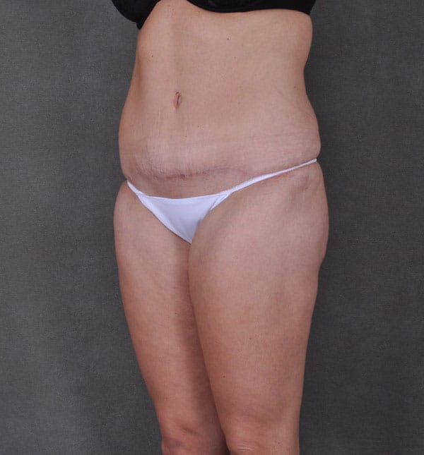 tummy tuck - patient 9171 - after 4 tummy tuck - patient 9171 - after 4