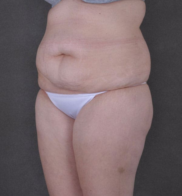 tummy tuck - patient 9171 - before 4 tummy tuck - patient 9171 - before 4