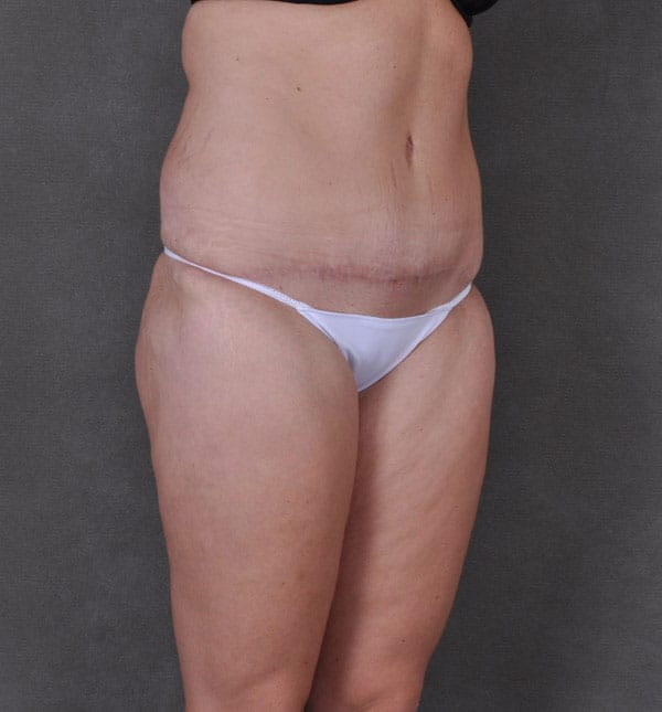 tummy tuck - patient 9171 - after 2 tummy tuck - patient 9171 - after 2