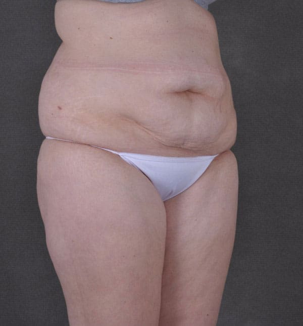 tummy tuck - patient 9171 - before 2 tummy tuck - patient 9171 - before 2