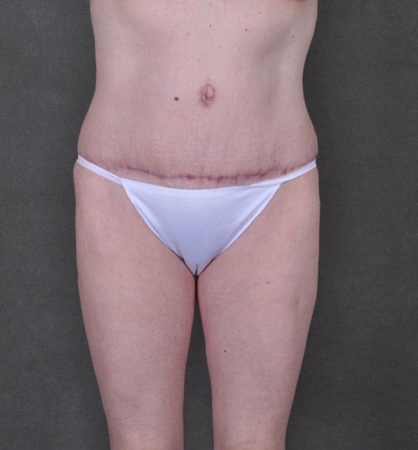 breast augmentation - patient 9173 - after 4 breast augmentation - patient 9173 - after 4