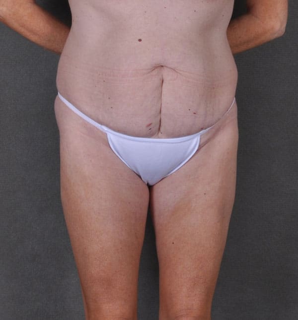 breast augmentation - patient 9173 - before 4 breast augmentation - patient 9173 - before 4