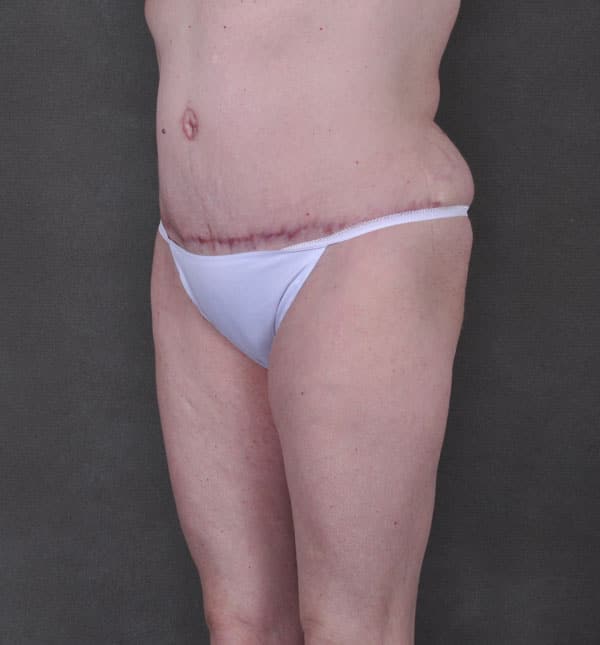 breast augmentation - patient 9173 - after 7 breast augmentation - patient 9173 - after 7
