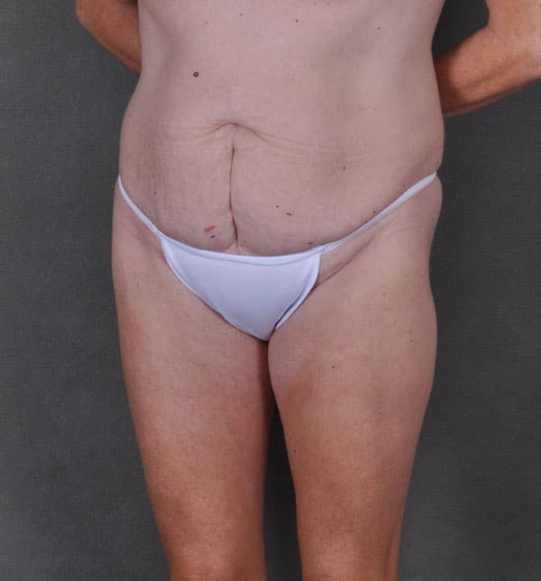 breast augmentation - patient 9173 - before 7 breast augmentation - patient 9173 - before 7