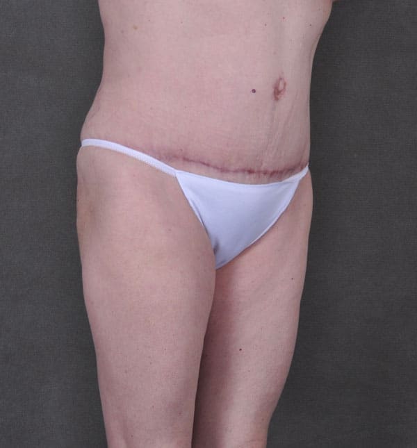 breast augmentation - patient 9173 - after 5 breast augmentation - patient 9173 - after 5