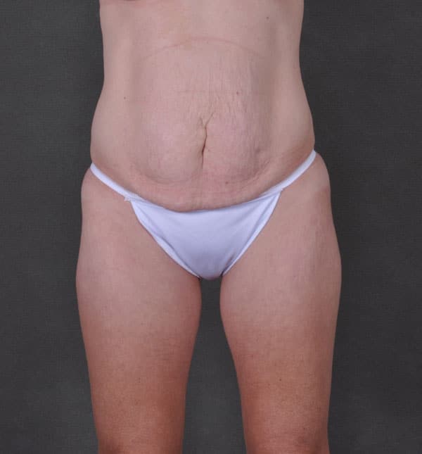 breast augmentation - patient 9227 - before 4 breast augmentation - patient 9227 - before 4