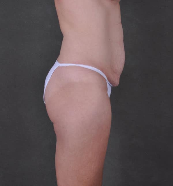 breast augmentation - patient 9227 - before 6 breast augmentation - patient 9227 - before 6