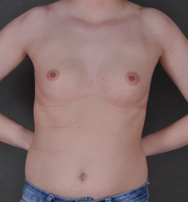 breast augmentation - patient 9248 - before 1 breast augmentation - patient 9248 - before 1