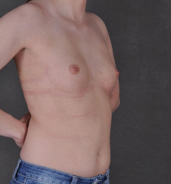 breast augmentation - patient 9248 - before 2 breast augmentation - patient 9248 - before 2