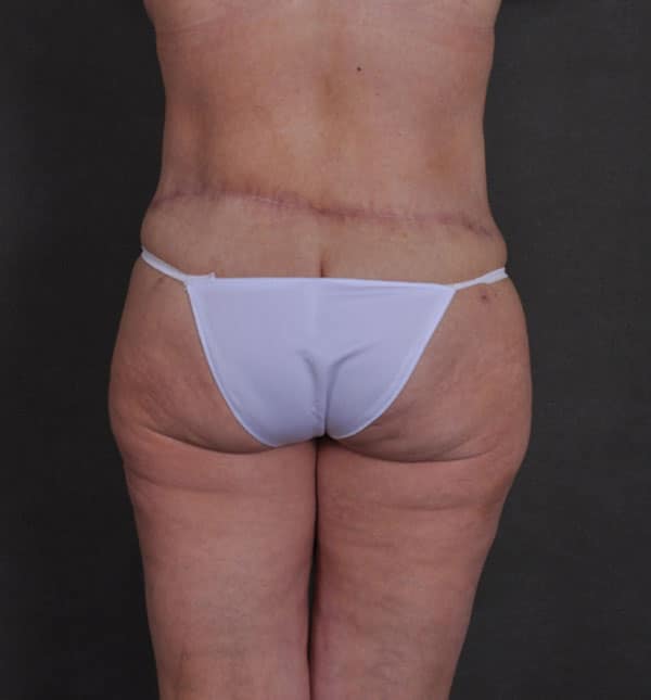 breast lift - patient 9298 - after 7 breast lift - patient 9298 - after 7