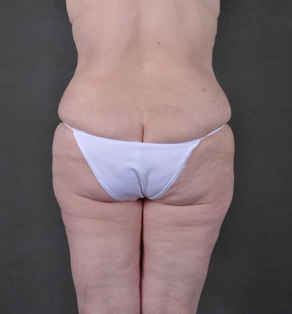 breast lift - patient 9298 - before 7 breast lift - patient 9298 - before 7
